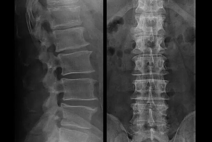 osteohondroze uz rentgena