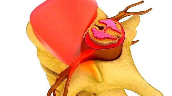 Krūšu mugurkaula osteohondroze slimības būtība
