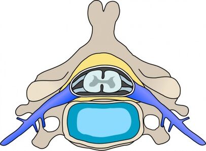 Protabius skriemelī ar dzemdes kakla osteohondrozi
